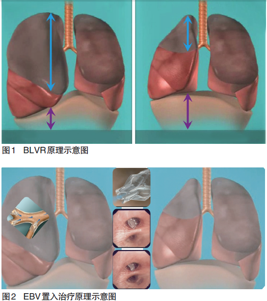 胸外科-胸腔镜肺减容术（LVRS）