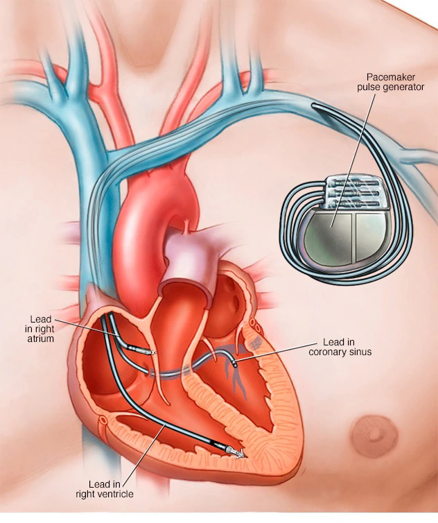 心脏永久起搏器植入术2.jpg