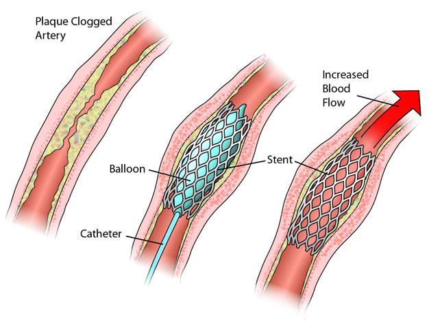 冠状动脉支架植入术2.jpg