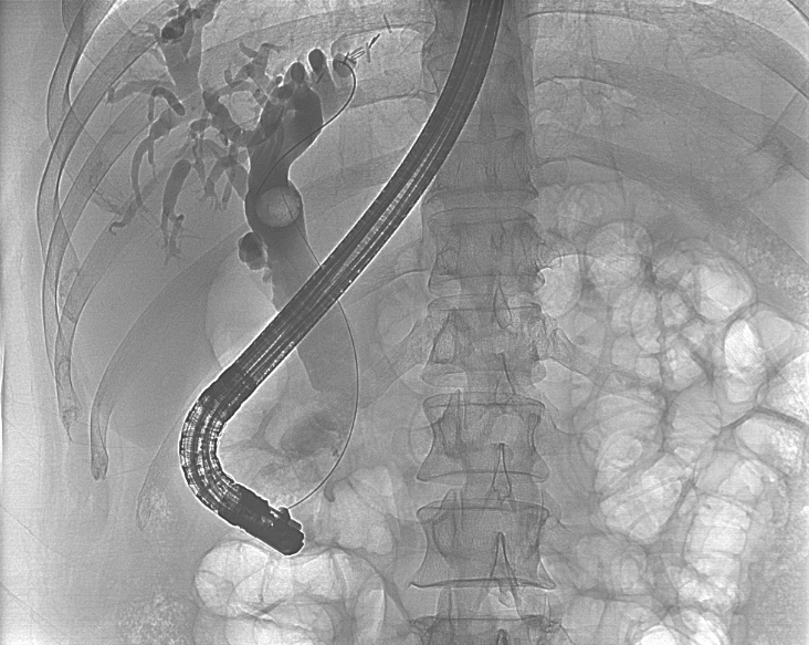 丁香园医院汇：9 年 4 次胆道手术，男子胆管结石反复发作，关键时刻 ERCP 来救命！