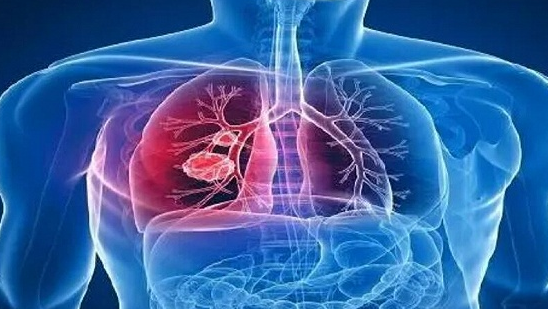肺部有结节用治疗吗|肺部结节是怎么形成的,怎样才能消除