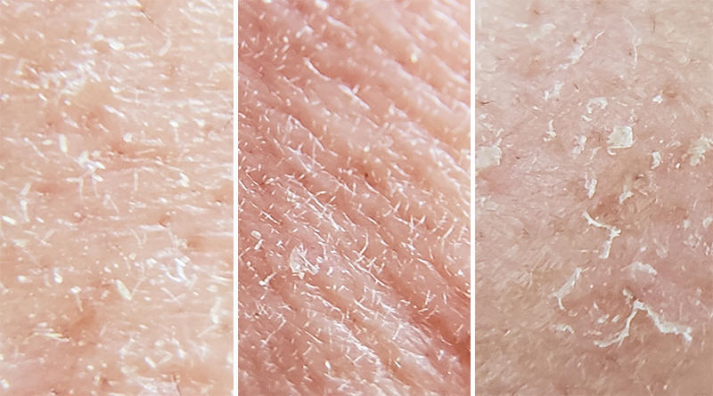 　　皮肤干燥起皮怎么办才能有效啊 ?皮肤干燥起皮是很多人都会遇到的问题，尤其是在干燥的季节或者空气湿度较低的环境中，更容易出现。以下是我们推荐的一些有效的方法，帮助您解决皮肤干燥起皮的问题。  　　保持足够的水分摄入  　　皮肤干燥起皮的原因之一是身体缺乏足够的水分，因此保持足够的水分摄入对于解决皮肤干燥问题非常重要。建议每天饮用足够的水，或者在皮肤干燥的部位涂抹保湿水或保湿乳液，为皮肤提供足够的水分。  　　选择合适的护肤品  　　选择适合自己的护肤品对于解决皮肤干燥起皮问题也非常重要。建议选择含有保湿成分的护肤品，如玻尿酸、甘油等，能够有效地为皮肤提供水分和保湿效果。另外，避免使用过多含酒精、香料等刺激性成分的护肤品，以免刺激皮肤，导致干燥起皮。  　　避免过度清洁  　　过度清洁皮肤会导致皮肤天然油脂的丢失，使皮肤更加干燥。建议避免使用过多含皂基的清洁产品，使用温和的清洁产品，如弱酸性洗面奶等。同时，避免频繁地使用热水洗脸，以免刺激皮肤。  　　饮食调节  　　饮食对于皮肤的健康也有很大的影响。建议多食用富含维生素C和维生素E的食物，如蔬菜、水果、坚果等，能够有效地帮助皮肤保持水分和防止干燥。  　　使用加湿器  　　在干燥的季节或者空气湿度较低的环境中，可以使用加湿器来增加室内空气的湿度，有助于缓解皮肤干燥起皮的问题。  　　需要注意的是，如果皮肤干燥起皮的情况较为严重，或者持续存在，应及时就医，寻求皮肤科医生的帮助。  　　总之，保持足够的水分摄入、选择合适的护肤品、避免过度清洁、饮食调节以及使用加湿器等方法都是缓解皮肤干燥起皮的有效方法。同时，我们也需要注意皮肤的状况，如果情况较为严重或者持续存在，应及时就医寻求专业的帮助。