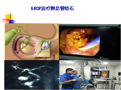肝胆外科治疗特色技术：ERCP及相关的检查治疗
