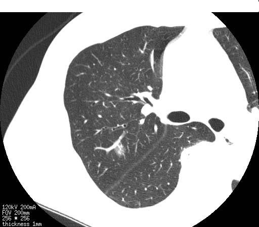 肺癌早期筛查第一选择：肺低剂量CT扫描