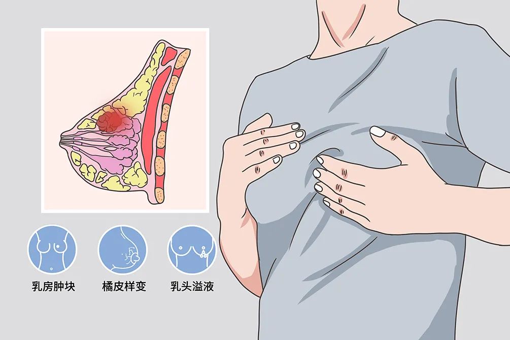 乳腺癌的早期症状和前兆筛查需要做什么检查|患了乳腺癌就要全切？未必！这样做五成患者可保乳！