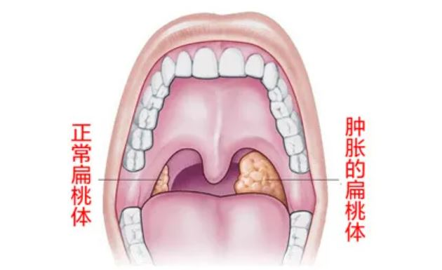 首例！6小时“超大号”手术，我院耳鼻喉科团队成功为患者切除扁桃体癌！