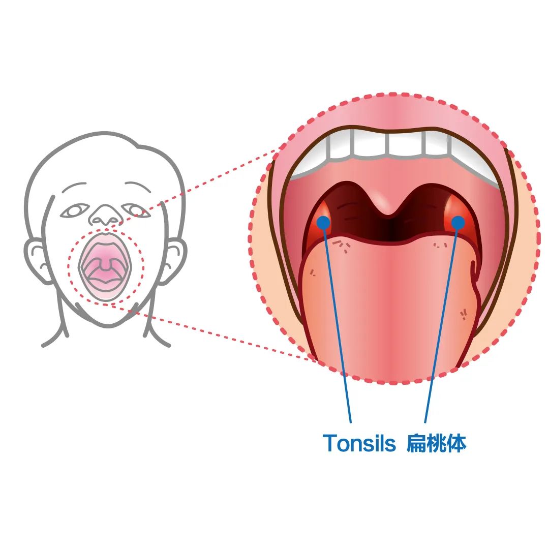 首例！6小时“超大号”手术，我院耳鼻喉科团队成功为患者切除扁桃体癌！