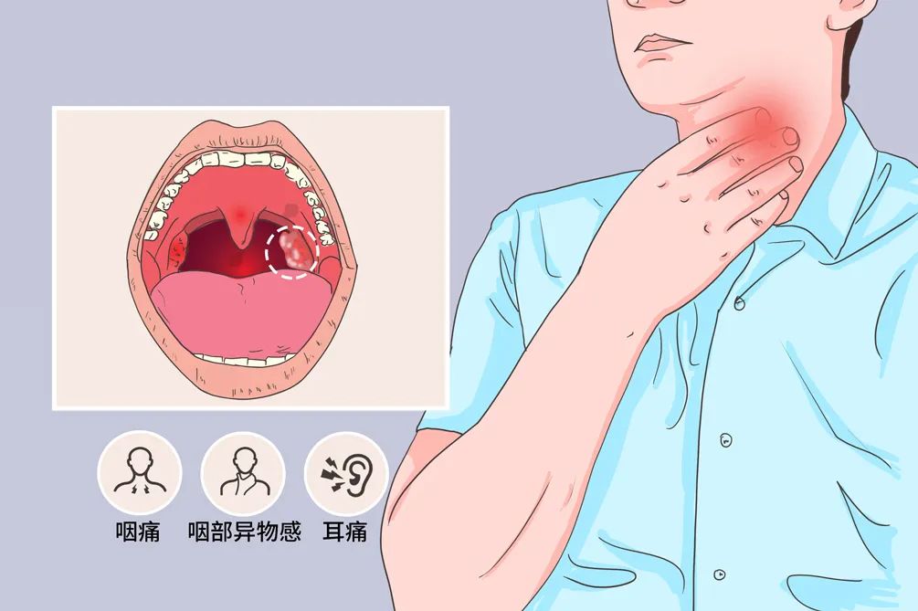 首例！6小时“超大号”手术，我院耳鼻喉科团队成功为患者切除扁桃体癌！