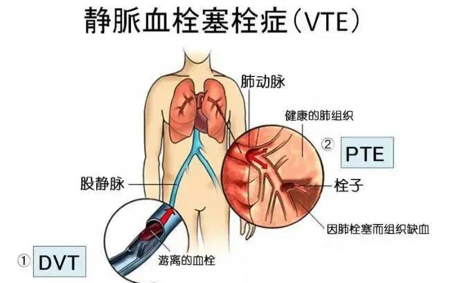 静脉血栓都有哪些症状怎么治疗最好的方法|新华医院增设【静脉血栓栓塞症（VTE）门诊】及【戒烟门诊】啦！