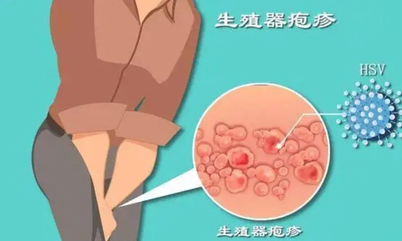 女性生殖器疱疹|女性生殖器疱疹：认识误区与预防控制
