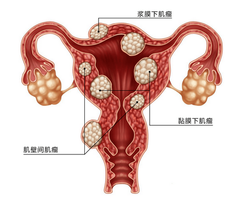 子宫肌瘤是什么原因导致的？川北医学院附属成都新华医院为您解答