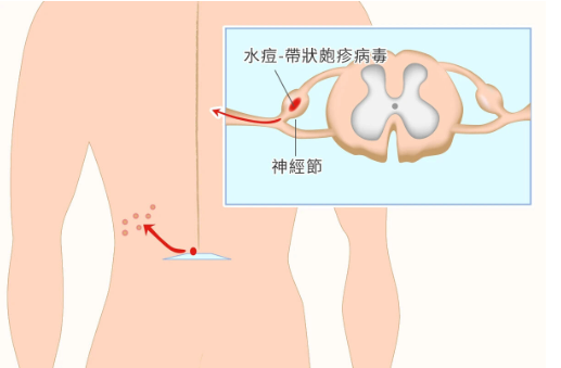 带状疱疹后遗症神经痛：新华医院创新疗法助力患者重获新生