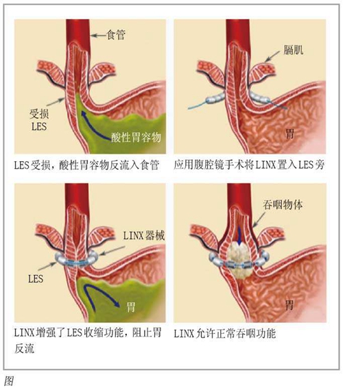 食道炎