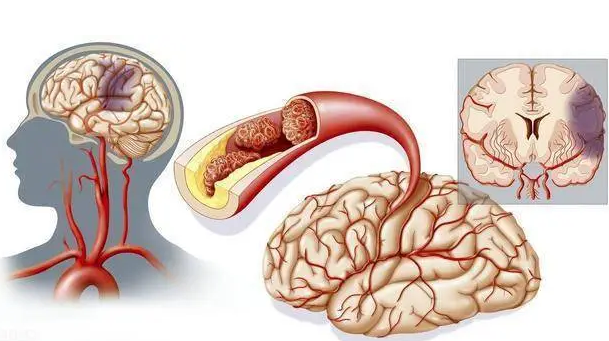 脑梗的症状都有哪些前期症状|脑梗是什么原因引起的前兆表现都有哪些