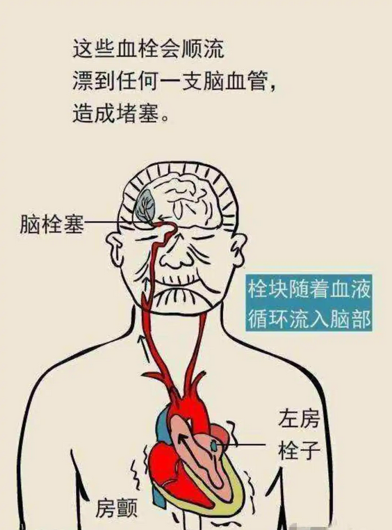 脑梗的症状都有哪些前期症状|脑梗是什么原因引起的前兆表现都有哪些