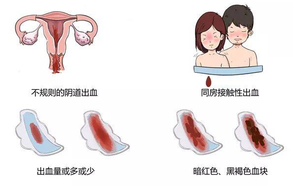 阴道出血怎么回事怎么治疗?不规则的阴道出血是怎么了?